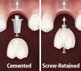implants-crowns
