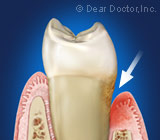 gum-disease8