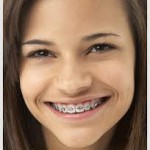 braces