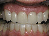 crown-after