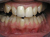 crown-before