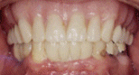 implants-after