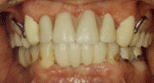 implants-before