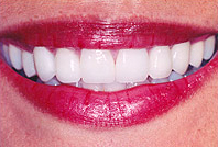 veneer-after