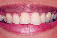veneer-before