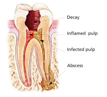 rootcanal1